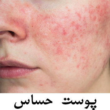 پوست حساس